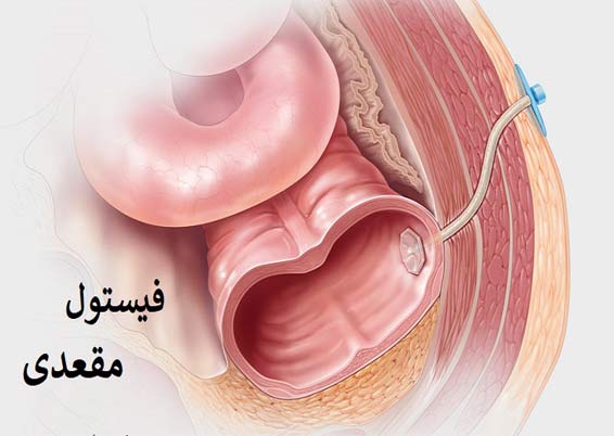 درمان فیستول