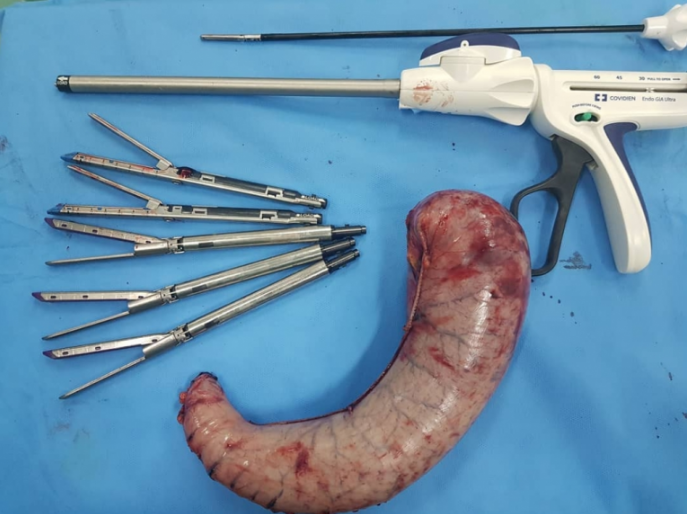 عمل جراحی اسلیو معده دکتر‌ جنگجو، متخصص جراحی‌های عمومی و فلوشیپ جراحی درون بین