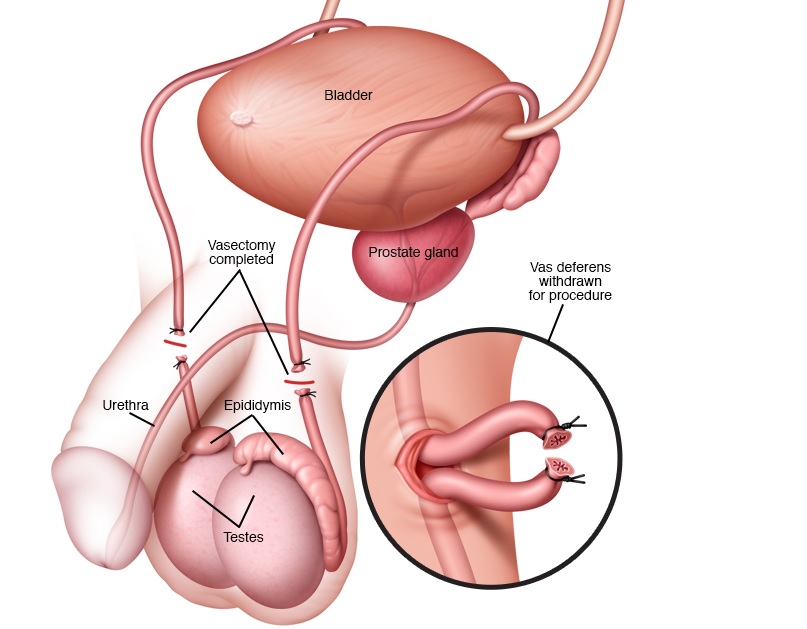 وازکتومی بدون تیغ جراحی | دکتر سعید محمدزاده