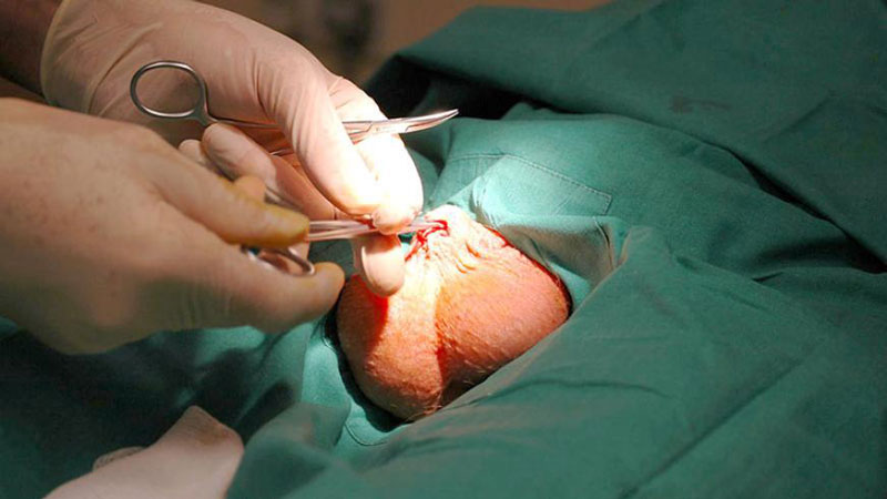 وازکتومی چیست؟ آیا بر انتقال بیماری های مقاربتی تاثیری دارد؟ - ایران اچ ای وی